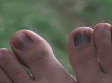 bruisedhikingtoes.jpg